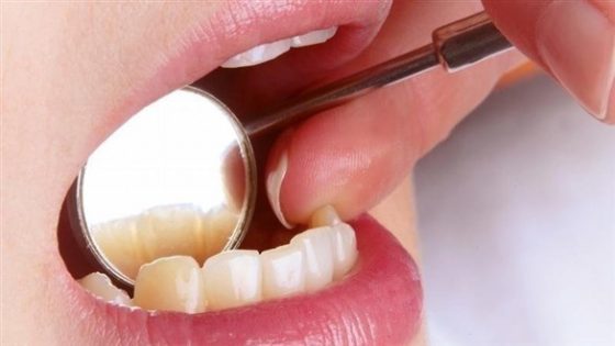 السكري يؤثر بالسلب على صحة الفم والأسنان