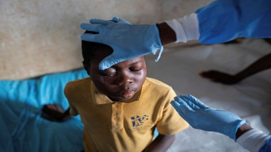 Lisungi Lifafu, 12, has his eyes checked by a nurse at the Yalolia health centre, in Yakusu, Tshopo, Democratic Republic of Congo, October 3, 2022. Without treatment, Lisungi can only wait for the illness to run its course. Ahead of him lies a myriad of possible outcomes including recovery, blindness, or, as was the case with a family member in August, death. "These children have a disease that makes them suffer so much," said Lisungi's father Litumbe Lifafu. "We demand the government provides medicines for us poor farmers, and the vaccine to fight this disease." REUTERS/Arlette Bashizi SEARCH "BASHIZI MONKEYPOX" FOR THIS STORY. SEARCH "WIDER IMAGE" FOR ALL STORIES. TPX IMAGES OF THE DAY NO RESALES. NO ARCHIVES